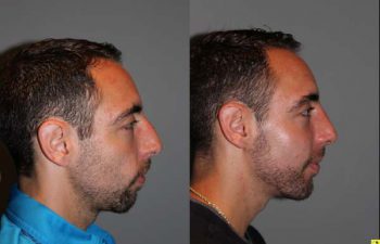 Male Rhinoplasty - 26 year old male 1 month post op following a rhinoplasty with chin implant.