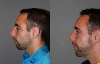 Male Rhinoplasty - 26 year old male 1 month post op following a rhinoplasty with chin implant.