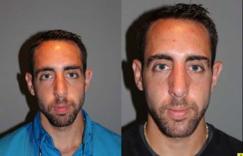 Male Rhinoplasty - 26 year old male 1 month post op following a rhinoplasty with chin implant.