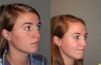 Rhinoplasty - 23 year old female one month post op from rhinoplasty.