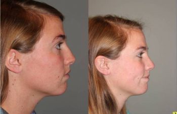 Rhinoplasty - 23 year old female one month post op from rhinoplasty.