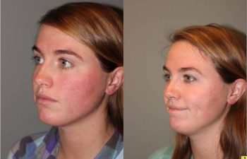 Rhinoplasty - 23 year old female one month post op from rhinoplasty.