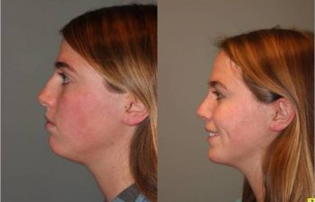 Rhinoplasty - 23 year old female one month post op from rhinoplasty.