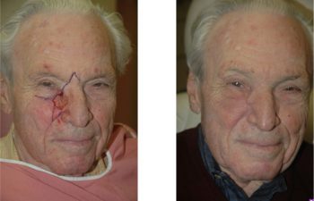 Before & After Combination local flap reconstruction - Problematic defect affecting two facial subunits requiring combination local flap reconstruction.