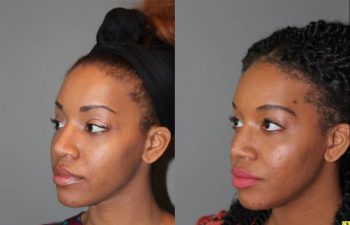 Rhinoplasty - 26 year old female 6 months following a revision ethnic rhinoplasty for a large bulbous tip following a primary rhinoplasty done by another surgeon