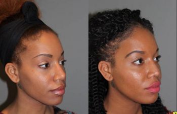 Rhinoplasty - 26 year old female 6 months following a revision ethnic rhinoplasty for a large bulbous tip following a primary rhinoplasty done by another surgeon