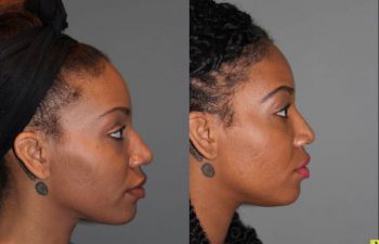 Rhinoplasty - 26 year old female 6 months following a revision ethnic rhinoplasty for a large bulbous tip following a primary rhinoplasty done by another surgeon