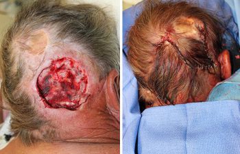 Before & After Large posterior Scalp Mohs Defect - Large posterior scalp Mohs defect closed using an opposing, rotation, advancement, multiflap closure technique.