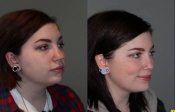 Rhinoplasty - 26 year old female 6 months following rhinoplasty for a large, over projected bulbous nasal tip and kybella injections for the double chin