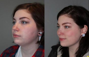 Rhinoplasty - 26 year old female 6 months following rhinoplasty for a large, over projected bulbous nasal tip and kybella injections for the double chin