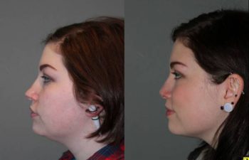 Rhinoplasty - 26 year old female 6 months following rhinoplasty for a large, over projected bulbous nasal tip and kybella injections for the double chin