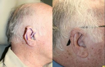 Before & After Cartilage defect of the helical rim - 77 year old male 3 months post op with skin and cartilage defect of the helical rim requiring V to Y advancement flap reconstruction to repair defect.