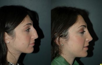 Cosmetic Rhinoplasty - Cosmetic Rhinoplasty performed on 27yo female for bridge/hump reduction and tip refinement.