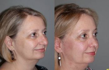 Cosmetic Rhinoplasty - Cosmetic Rhinoplasty performed on 59yo female to reduce the over all size, the bridge or hump, and to elevate and refine the tip.