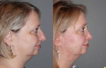 Cosmetic Rhinoplasty - Cosmetic Rhinoplasty performed on 59yo female to reduce the over all size, the bridge or hump, and to elevate and refine the tip.