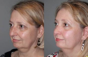 Cosmetic Rhinoplasty - Cosmetic Rhinoplasty performed on 59yo female to reduce the over all size, the bridge or hump, and to elevate and refine the tip.