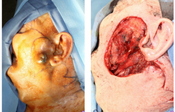 Before & After Wide local excision for melanoma with a secondary large lateral cheek defect - 82 year old male undergoing wide local excision for melanoma with a secondary large lateral cheek defect requiring a cervicofacial myocutaneous bilobed flap reconstruction.