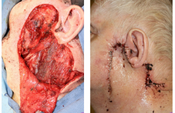 Before & After Wide local excision for melanoma with a secondary large lateral cheek defect - 82 year old male undergoing wide local excision for melanoma with a secondary large lateral cheek defect requiring a cervicofacial myocutaneous bilobed flap reconstruction.