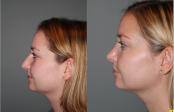 Cosmetic Rhinoplasty - Cosmetic Rhinoplasty performed on 29yo female for bridge/hump reduction and tip refinement. Right side view.