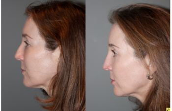 Blepoharoplasty/Rhinoplasty - 52 yo female s/p upper blepoharoplasty, lower blepharoplasty with fat transposition, and a rhinoplasty to refine tip and narrow bridge. Patient requested subtle results and not to alter height of the bridge of her nose.