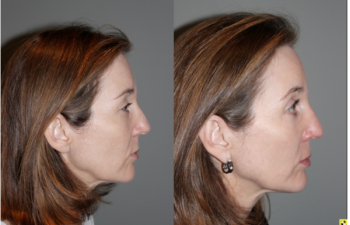 Blepoharoplasty/Rhinoplasty - 52 yo female s/p upper blepoharoplasty, lower blepharoplasty with fat transposition, and a rhinoplasty to refine tip and narrow bridge. Patient requested subtle results and not to alter height of the bridge of her nose.