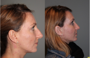 Rhinoplasty - 39 year old female 3 months following her rhinoplasty