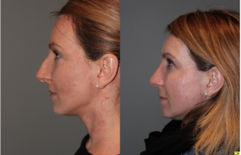 Rhinoplasty - 39 year old female 3 months following her rhinoplasty