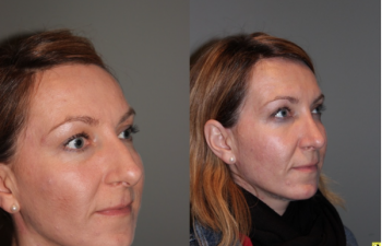 Rhinoplasty - 39 year old female 3 months following her rhinoplasty