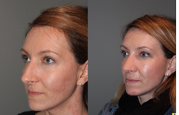 Rhinoplasty - 39 year old female 3 months following her rhinoplasty