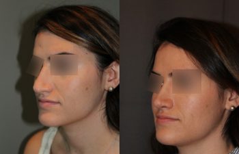 Revision Rhinoplasty - This patient had a revision rhinoplasty where Dr. Stong revised a previous rhinoplasty from another surgeon.