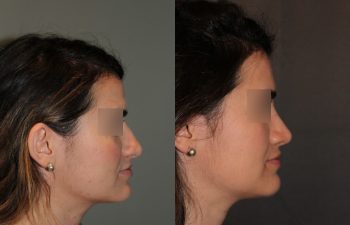 Revision Rhinoplasty - This patient had a revision rhinoplasty where Dr. Stong revised a previous rhinoplasty from another surgeon.