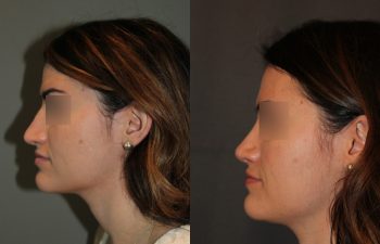 Revision Rhinoplasty - This patient had a revision rhinoplasty where Dr. Stong revised a previous rhinoplasty from another surgeon.