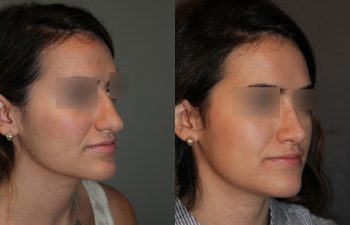 Revision Rhinoplasty - This patient had a revision rhinoplasty where Dr. Stong revised a previous rhinoplasty from another surgeon.