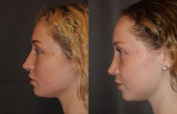 Revision Rhinoplasty - This patient had a revision rhinoplasty where Dr. Stong revised a previous rhinoplasty from another surgeon.