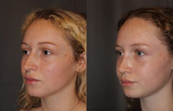 Revision Rhinoplasty - This patient had a revision rhinoplasty where Dr. Stong revised a previous rhinoplasty from another surgeon.