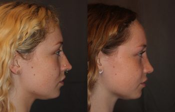 Revision Rhinoplasty - This patient had a revision rhinoplasty where Dr. Stong revised a previous rhinoplasty from another surgeon.