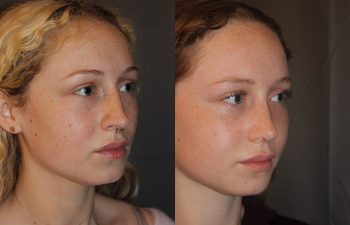 Revision Rhinoplasty - This patient had a revision rhinoplasty where Dr. Stong revised a previous rhinoplasty from another surgeon.