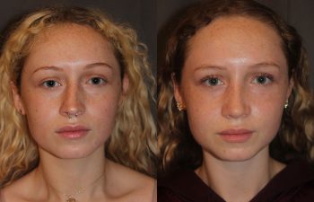 Revision Rhinoplasty - This patient had a revision rhinoplasty where Dr. Stong revised a previous rhinoplasty from another surgeon.