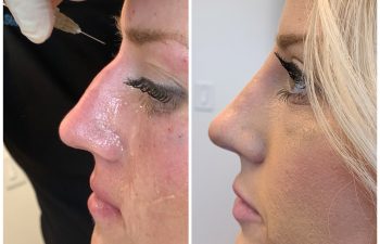 Female Patient before and after Liquid Rhinoplasty