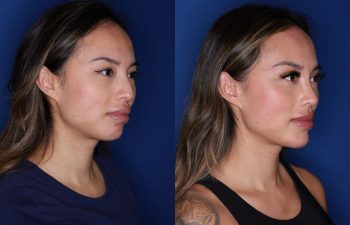 🥇 Atlanta Facial Cosmetic Surgery Before and After Photos