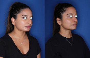 31 year old female 11 months post op from cosmetic rhinoplasty