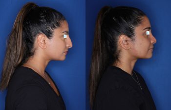 31 year old female 11 months post op from cosmetic rhinoplasty