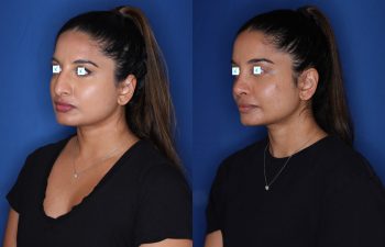 31 year old female 11 months post op from cosmetic rhinoplasty