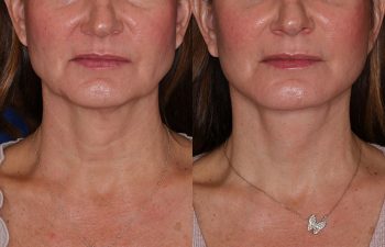 50 year old female 2 months post op from extended deep plane facelift with platysmaplasty.