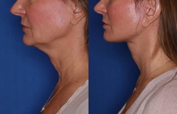 50 year old female 2 months post op from extended deep plane facelift with platysmaplasty.