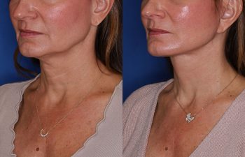 50 year old female 2 months post op from extended deep plane facelift with platysmaplasty.