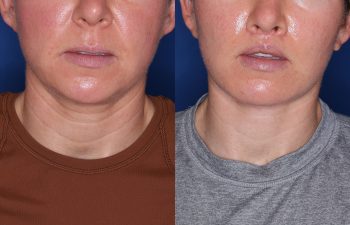 36 year old female 2 months post op from KalosLift (Extended Deep Plane Facelift,) platysmaplasty, Perialar Lip Lift, and buccal fat pad removal.