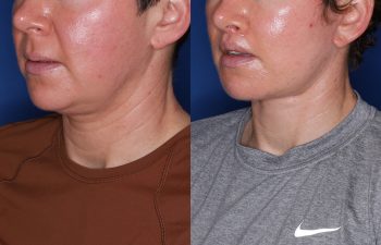 36 year old female 2 months post op from KalosLift (Extended Deep Plane Facelift,) platysmaplasty, Perialar Lip Lift, and buccal fat pad removal.