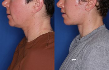 36 year old female 2 months post op from KalosLift (Extended Deep Plane Facelift,) platysmaplasty, Perialar Lip Lift, and buccal fat pad removal.