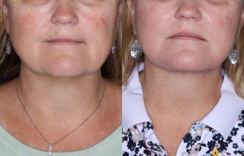 57 year old female 2 months post op from undergoing a KalosLift (Extended Deep Plane Facelift) and platysmaplasty.